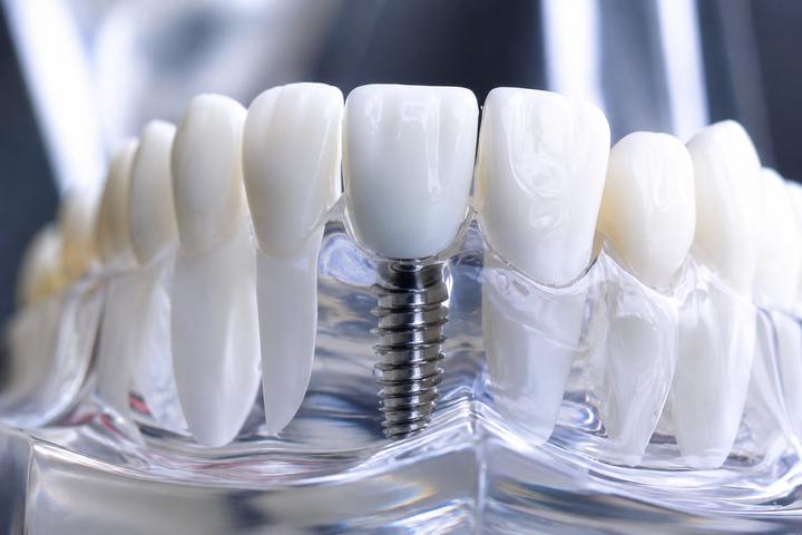 Implantate
