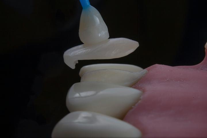 Veneers